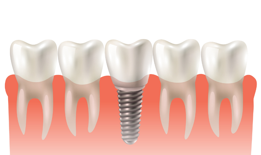 About Dental Implants And Their Benefits