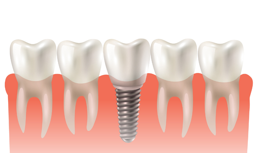Local Affordable Dental Implant Quotes Near Me in Jacksonville, Florida thumbnail