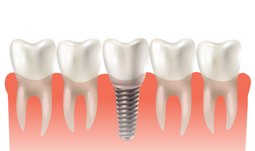 dental implant