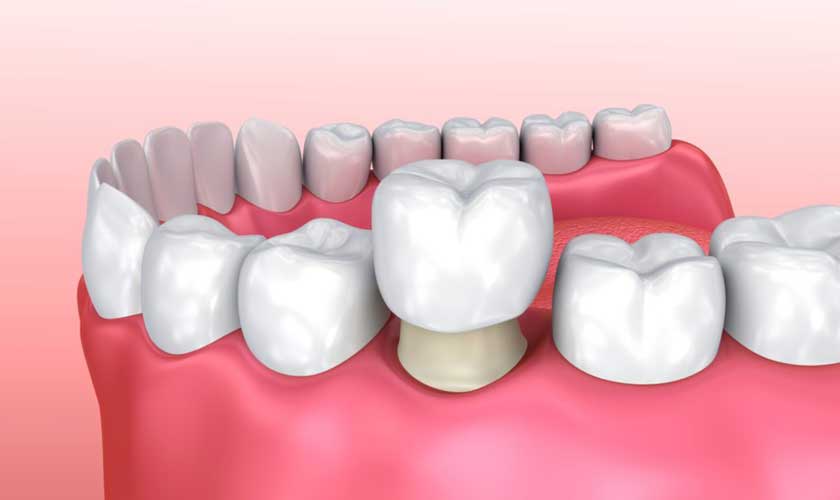 Know about different types of Dental Crowns and Their Cost