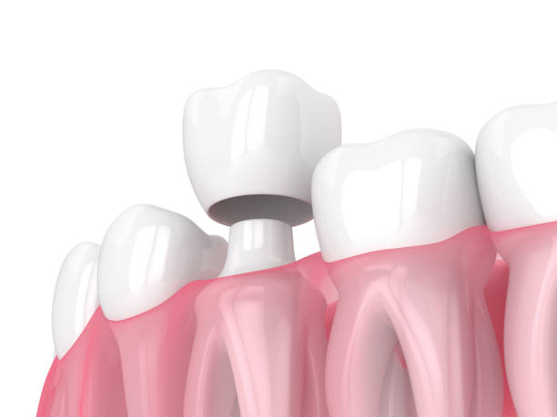 Dental Crowns: What Are Its Types and Its Benefits?