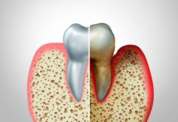 Periodontitis: Causes, Symptoms and Treatment!