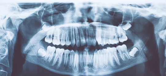 DENTAL X-RAYS: WHAT YOU NEED TO KNOW BEFORE VISITING YOUR DENTIST