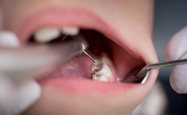 The Best Ways To Deal With Early Cavities
