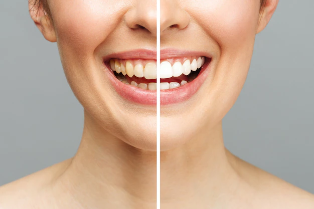 Answering 8 Common Questions On Teeth Whitening
