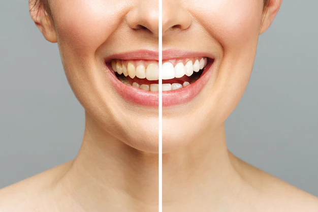 teeth whitening in jacksonville