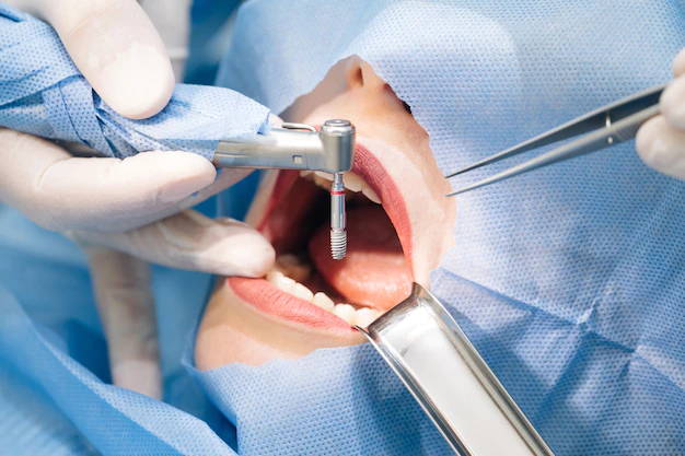 dental implants jacksonville