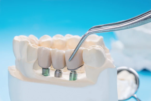 Dental Crowns- Types, Costs, Benefits