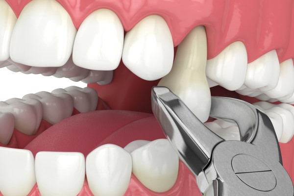 Dental Extractions And Oral Health: Impact On Adjacent Teeth