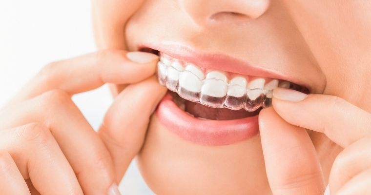 The Impact Of Invisalign For A Straighter Smile