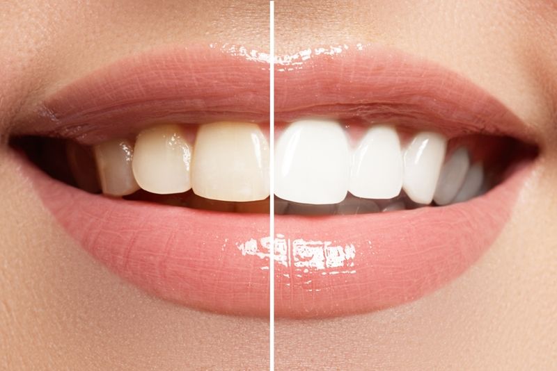 Teeth Whitening-after and before effect of teeth whitening