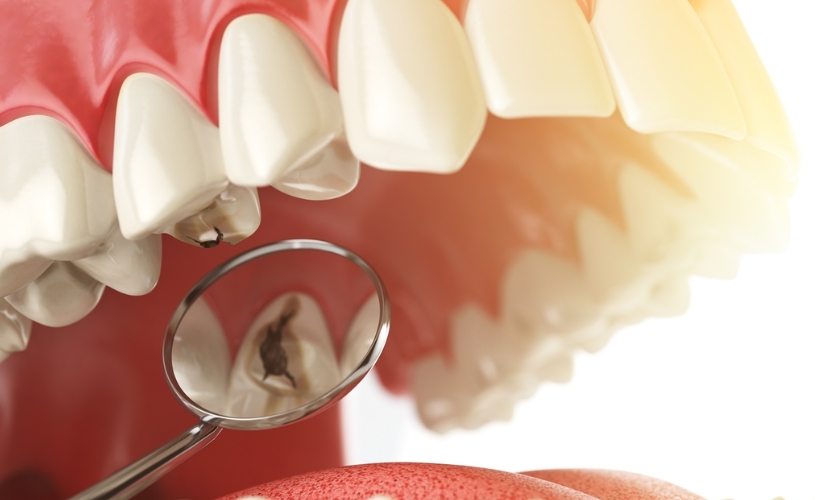 Learn how cavity become an emergency by emergency dentist