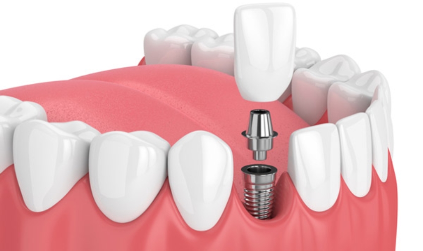Graphical image of Dental Implant- what to expect after dental implant surgery