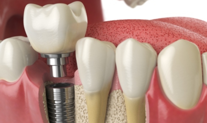 What I Need To Know Before Getting Dental Implant Surgery