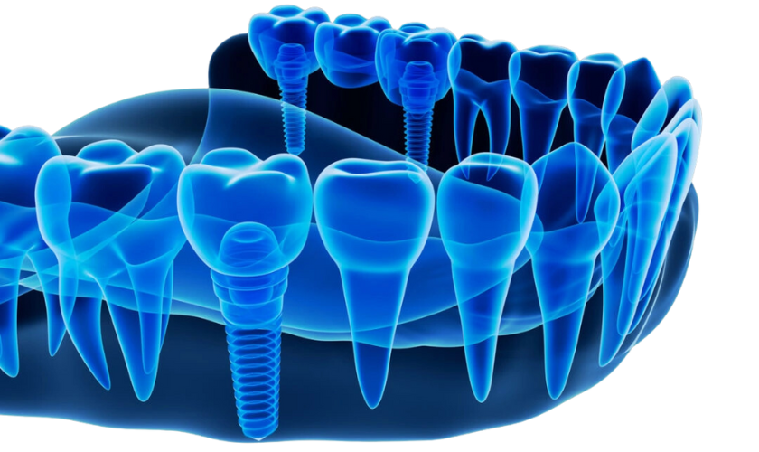 Image of Dental Implants - Eating And Oral Care After Getting Dental Implants: Dos And Don'ts
