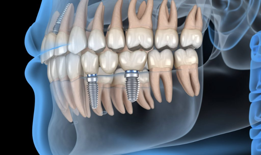 Preparing For Dental Implant Surgery In The New Year