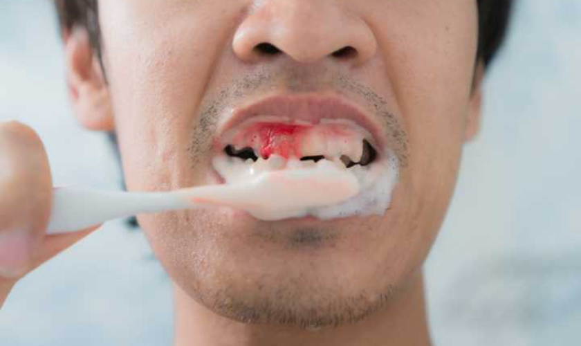How Do You Stop Bleeding When Brushing Your Teeth?
