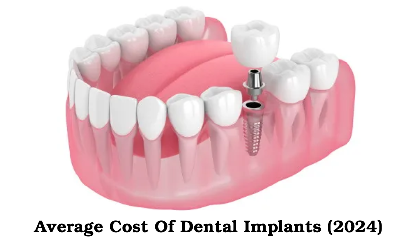 What Is The Average Cost Of One Dental Implant